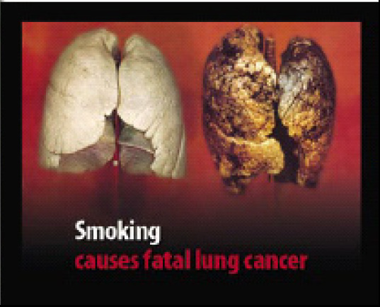 EU 2004 Health Effects lung - diseased organ, lung cancer, gross
